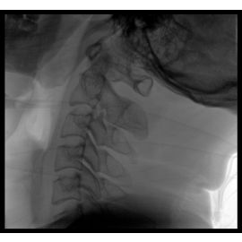 Perlove Medical Factory Price C Arm for Vertebroplasty Medical Equipment Supplier in China