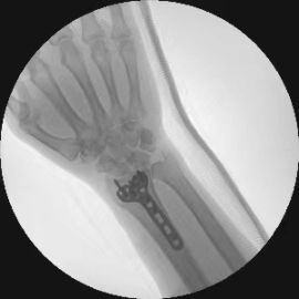Perlove Medical X-ray Radiotherapy Machine C-arm PLX112B Free Sample for Spinal Surgery Electric Power Source